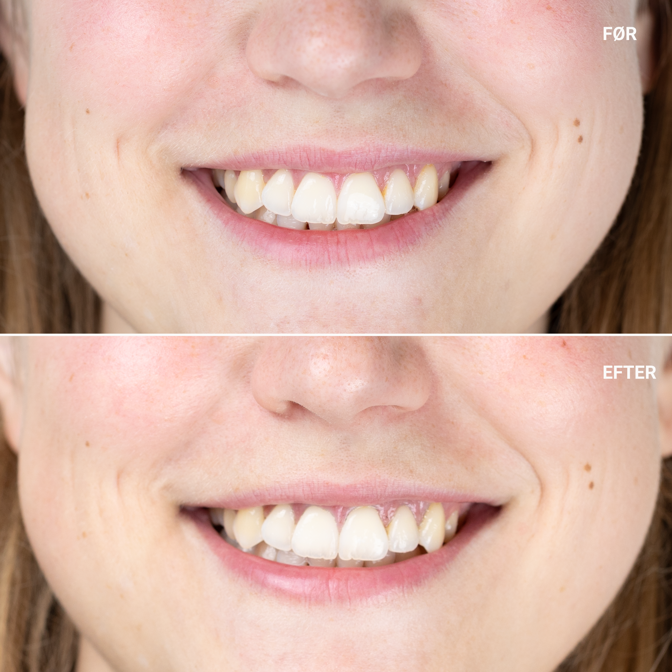 CHARCOAL TEETH WHITENING